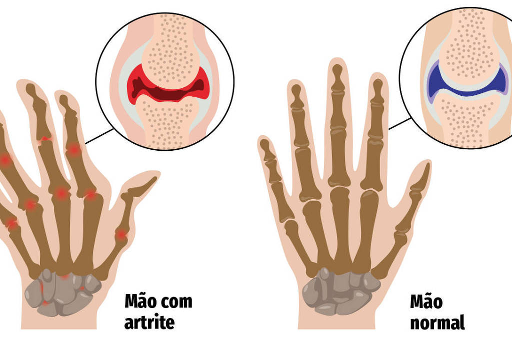 Dores-nas-articulações-são-um-alerta-para-artrite-e-artrose-07022021-São-Paulo.jpg